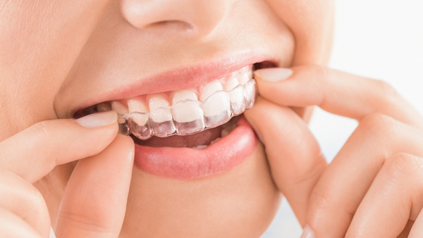 Aparelho Invisível em Curitiba - Invisalign